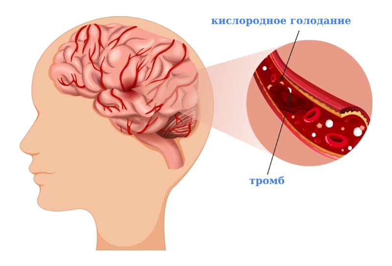 Ишемический инсульт