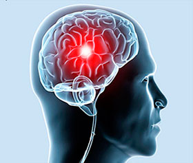 Профилактика инсульта